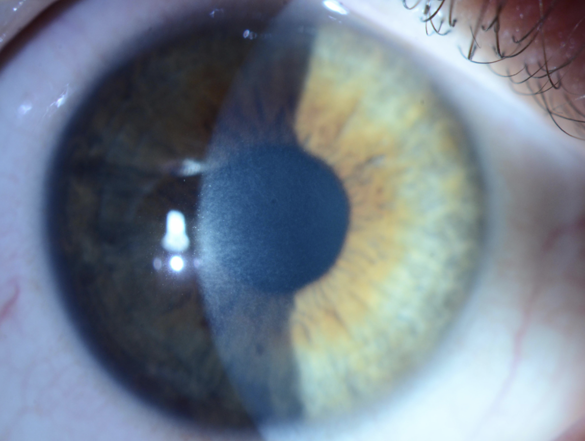Fig. 4. Many of the newer PRK techniques reduce risk of postoperative corneal haze formation.