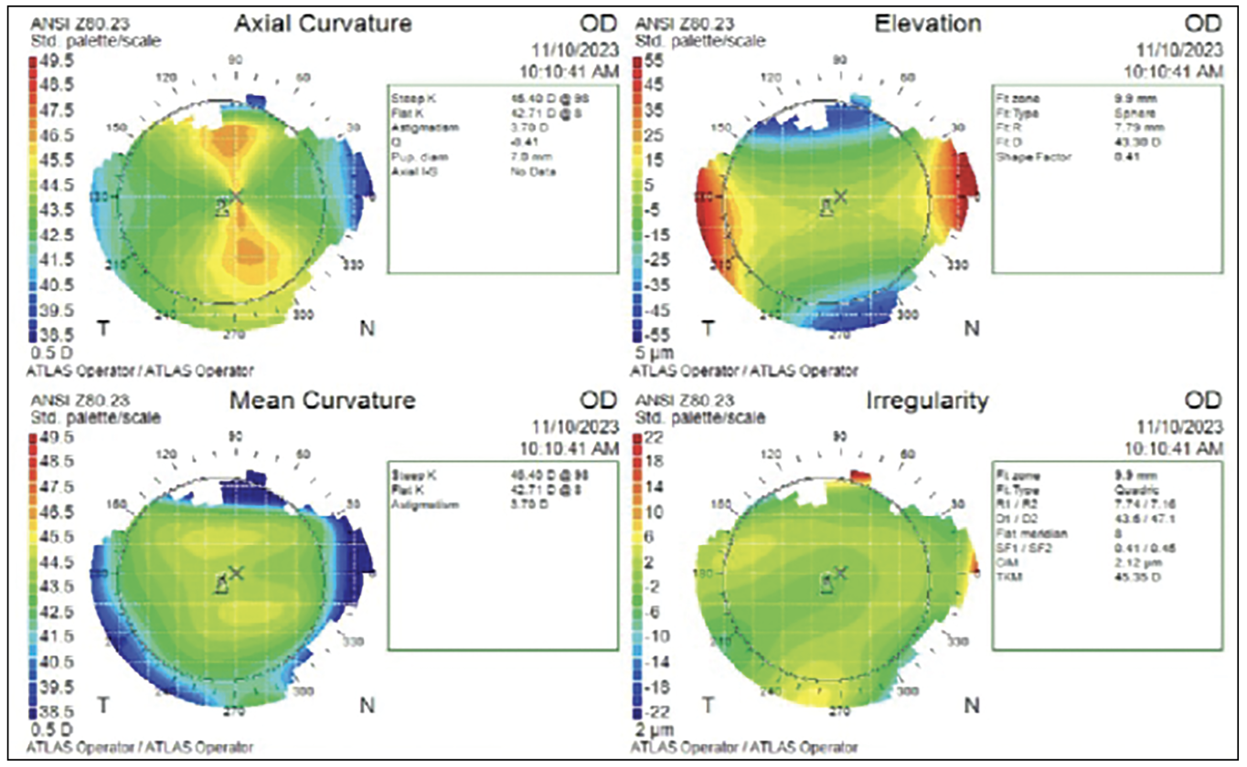 Fig. 5. Preoperative corneal topography of the right eye was obtained prior to PRK. The left eye (not pictured) won’t be operated on, as its inherent manifest refraction of -1.50D provides good near vision. To ensure patient adaptation to monovision, a contact lens trial was conducted before surgery simulating the anticipated post-op refractive outcome.