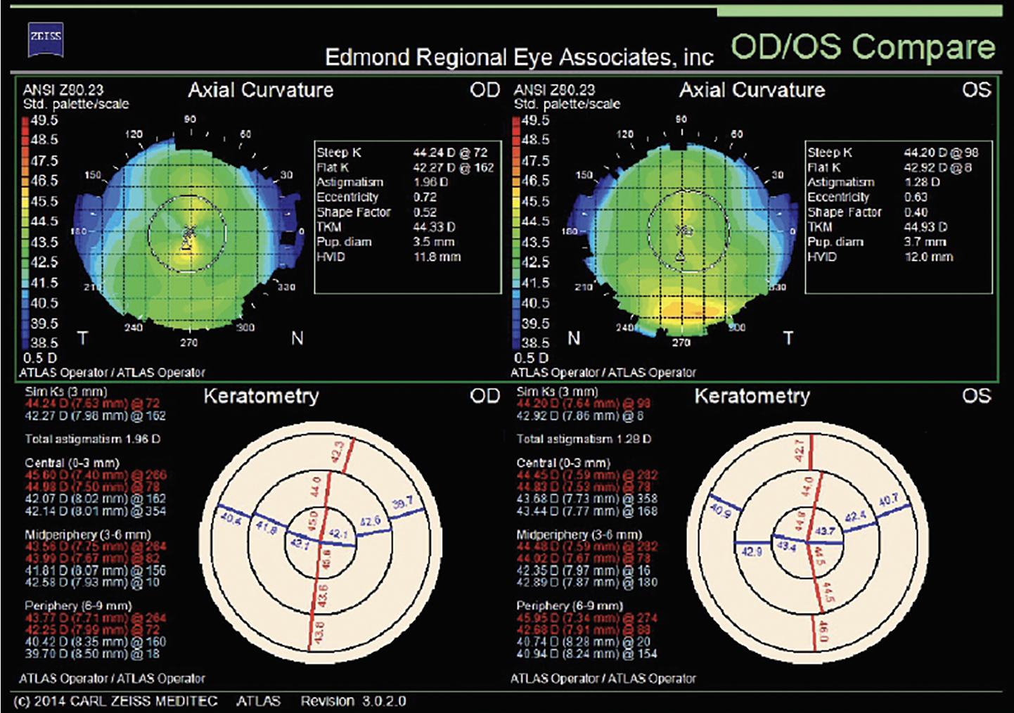 Fig. 6. Preoperative topographies OU before topography-guided PRK with a target of plano sphere OU.