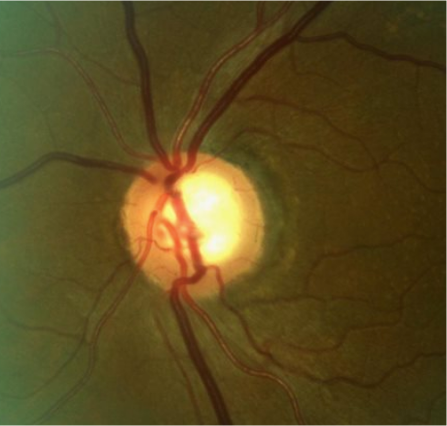 In this study, underdiagnosis of POAG was more common than overdiagnosis. Of the 13.8% of subjects who experienced a diagnostic change within two years after their initial visit—upstaging from POAG suspect to POAG or vice versa—77.9% involved cases of advancing disease. 